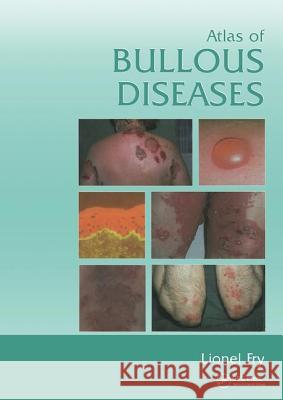 Atlas of Bullous Diseases Lionel Fry 9780415383387 Informa Healthcare