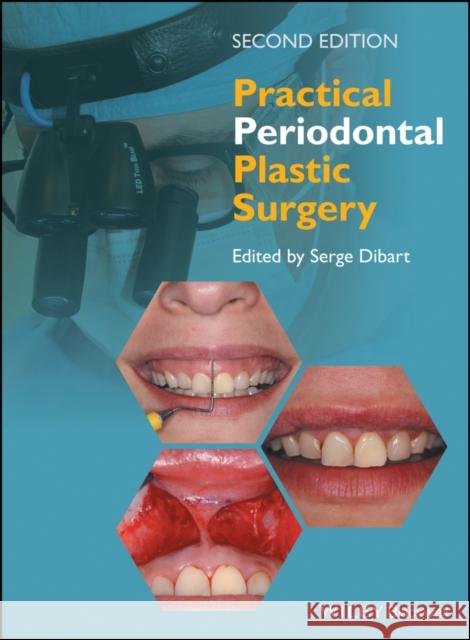 Practical Periodontal Plastic Surgery Serge Dibart 9781118360651 Wiley-Blackwell