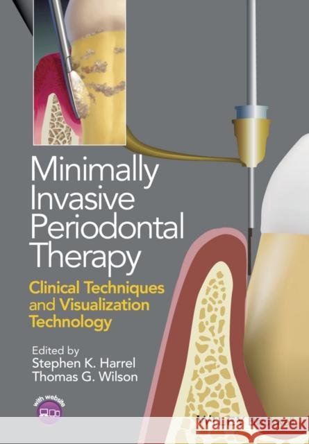Minimally Invasive Periodontal Therapy: Clinical Techniques and Visualization Technology Harrel, Stephen K.; Wilson, Thomas G. 9781118607626 John Wiley & Sons
