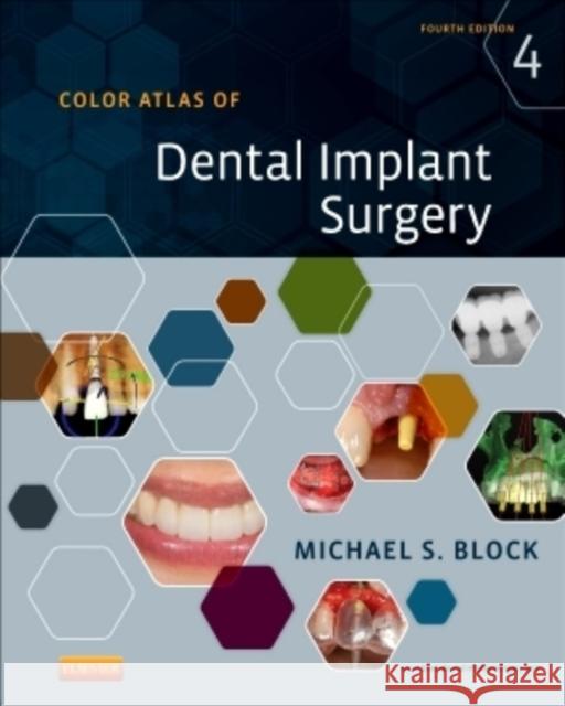 Color Atlas of Dental Implant Surgery Michael S. Block 9781455759682 W.B. Saunders Company
