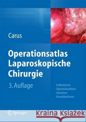 Operationsatlas Laparoskopische Chirurgie: Indikationen - Operationsablauf - Varianten - Komplikationen Carus, Thomas 9783642312458 Springer