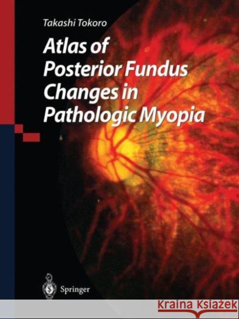 Atlas of Posterior Fundus Changes in Pathologic Myopia Takashi Tokoro T. Tokoro 9784431702252 Springer