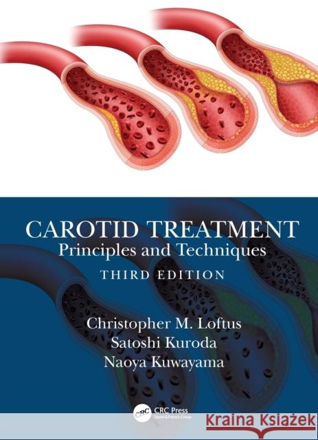 Carotid Treatment: Principles and Techniques Christopher M. Loftus Satoshi Kuroda Naoya Kuwayama 9780367465711 Taylor & Francis Ltd - książka